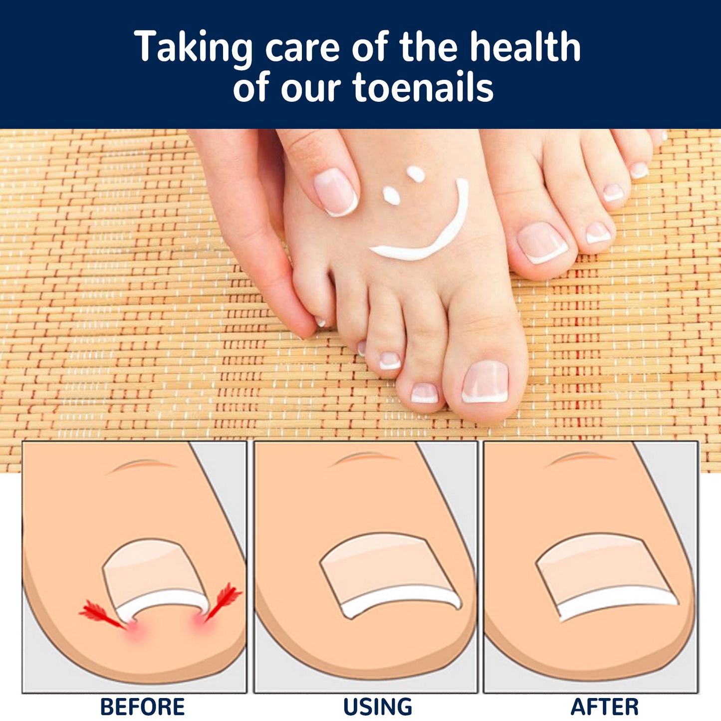 EELHOE Toe Nail Correction Stickers Nail Inlay Correction Repair Toe Nail Toenail Straightening Sticker