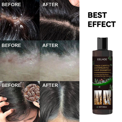 EELHOE Anti-Fungal Itchy Scalp Shampoo Anti-Dandruff Refreshing Oil Control Hair Care Anti-Itch Shampoo