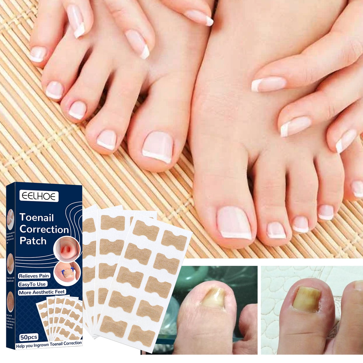 EELHOE Toe Nail Correction Stickers Nail Inlay Correction Repair Toe Nail Toenail Straightening Sticker