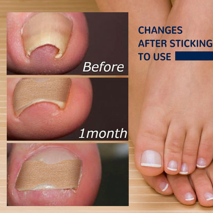 EELHOE Toe Nail Correction Stickers Nail Inlay Correction Repair Toe Nail Toenail Straightening Sticker