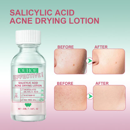 OUHOE Salicylic Acid Acne Lotion Gentle Repair Acne Skin Pore Refinement Facial Moisturizing Lotion