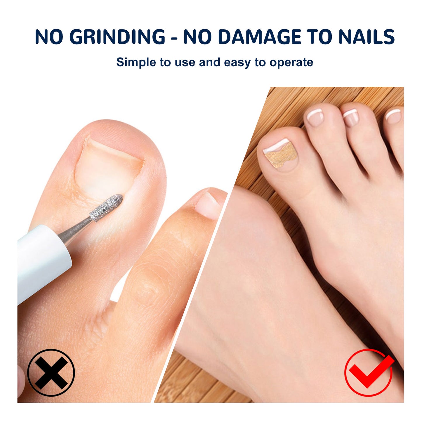 EELHOE Toe Nail Correction Stickers Nail Inlay Correction Repair Toe Nail Toenail Straightening Sticker